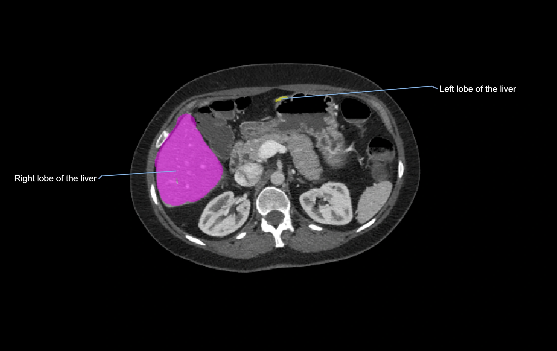 CT lliver lobes axial cross sectional anatomy labelled image -00034.webp